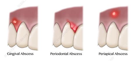 abscess plural|types of abscesses.